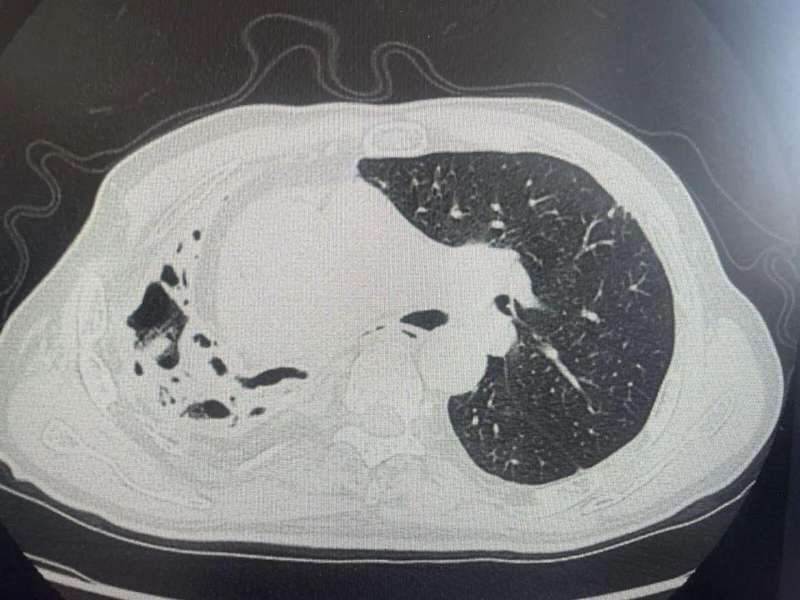春日挖笋乐趣多;老人肺部却遭重创,医生反复强调防护要点。 健康养生